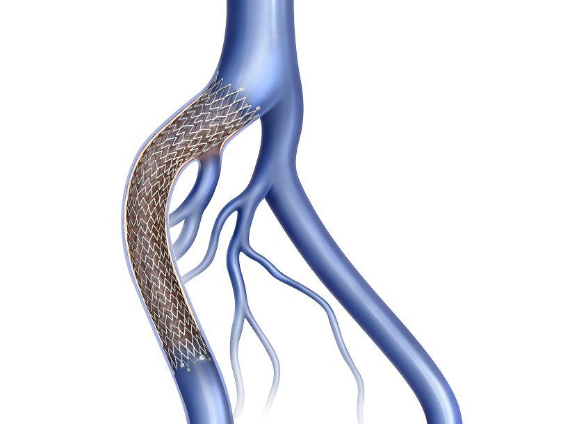 Venovo™ Venous Stent System